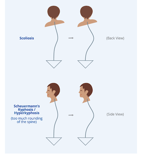 Kyphosis: What Is It & How Is It Different from Scoliosis? - The ...